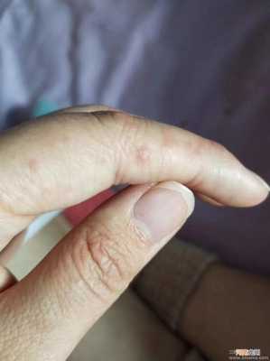孕期手长湿疹怎么办(孕妇长湿疹怎么办) 第2张 孕期手长湿疹怎么办(孕妇长湿疹怎么办) 第2张