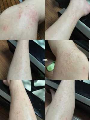 孕妇得湿疹怎么治,孕妇孕期长湿疹怎么办啊 第1张 孕妇得湿疹怎么治,孕妇孕期长湿疹怎么办啊 第1张