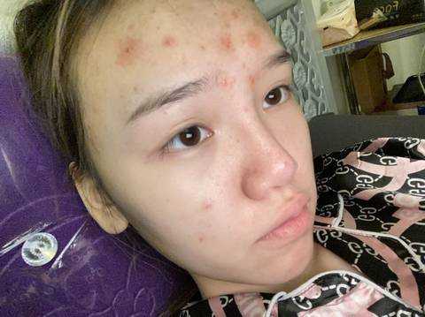 怀孕期间脸上长痘痘怎么办,怀孕期间脸上长痘痘怎么办 第3张 怀孕期间脸上长痘痘怎么办,怀孕期间脸上长痘痘怎么办 第3张