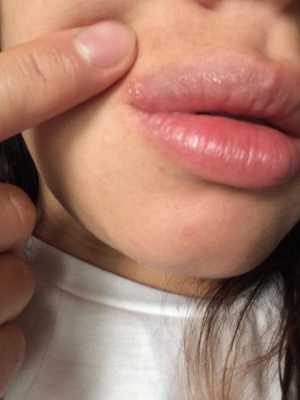 有孕期长了口唇疱疹的吗,孕期嘴唇长疱疹怎么办才好得快 第2张 有孕期长了口唇疱疹的吗,孕期嘴唇长疱疹怎么办才好得快 第2张