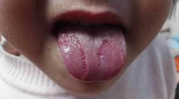 孕妇地图舌影响胎儿吗(孕妇地图舌对胎儿有影响吗) 第2张 孕妇地图舌影响胎儿吗(孕妇地图舌对胎儿有影响吗) 第2张