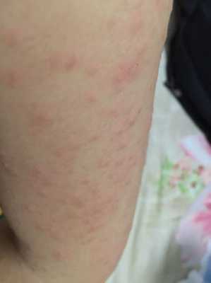 怀孕11周,胳膊、腿上身上长了好多湿疹,痒的受不了,有什么,孕期脸上长湿疹怎么办啊 第2张 怀孕11周,胳膊、腿上身上长了好多湿疹,痒的受不了,有什么,孕期脸上长湿疹怎么办啊 第2张