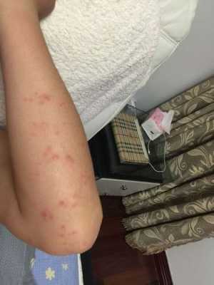 怀孕11周,胳膊、腿上身上长了好多湿疹,痒的受不了,有什么,孕期脸上长湿疹怎么办啊 第1张 怀孕11周,胳膊、腿上身上长了好多湿疹,痒的受不了,有什么,孕期脸上长湿疹怎么办啊 第1张