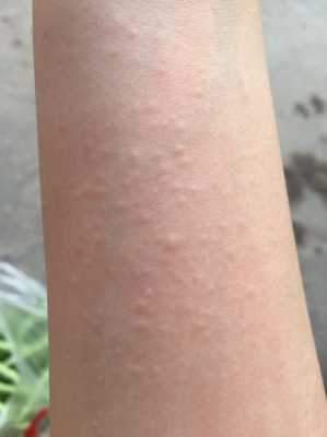 孕期皮肤瘙痒是什么原因,孕期皮肤过敏怎么办小妙招 第2张 孕期皮肤瘙痒是什么原因,孕期皮肤过敏怎么办小妙招 第2张