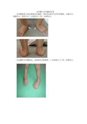 三岁孩子脚内翻是什么原因,胎儿足内翻的原因有哪些  第1张