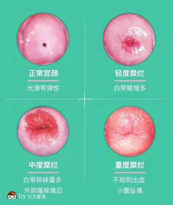 怀孕期间宫颈糜烂出血(怀孕期间宫颈糜烂出血怎么办) 第1张 怀孕期间宫颈糜烂出血(怀孕期间宫颈糜烂出血怎么办) 第1张