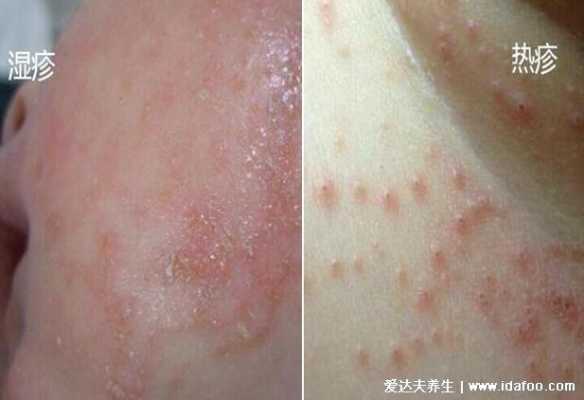 孕期长湿疹是什么原因(孕期长湿疹是什么原因导致的) 第1张 孕期长湿疹是什么原因(孕期长湿疹是什么原因导致的) 第1张