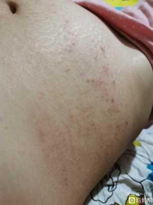 孕期肚子长湿疹怎么办（孕晚期大腿内侧长湿疹的很痒怎么治疗）  第2张