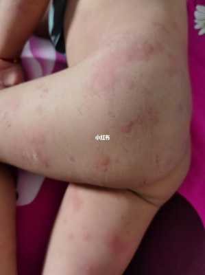 孕期荨麻疹会影响胎儿(孕期荨麻疹会影响胎儿吗) 第2张 孕期荨麻疹会影响胎儿(孕期荨麻疹会影响胎儿吗) 第2张