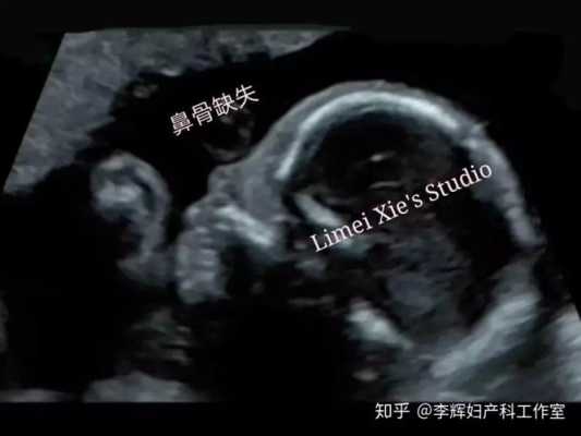 12周胎儿鼻骨缺失是畸形吗,胎儿鼻骨缺失是畸形吗图片 第2张 12周胎儿鼻骨缺失是畸形吗,胎儿鼻骨缺失是畸形吗图片 第2张