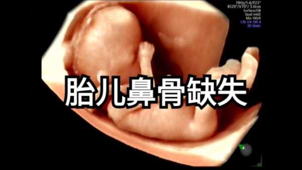 12周胎儿鼻骨缺失是畸形吗,胎儿鼻骨缺失是畸形吗图片 第3张 12周胎儿鼻骨缺失是畸形吗,胎儿鼻骨缺失是畸形吗图片 第3张