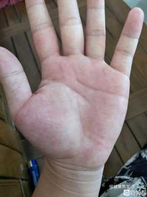 孕晚期突然手掌脚板痒是怎么回事,孕期手掌很痒怎么回事啊 第1张 孕晚期突然手掌脚板痒是怎么回事,孕期手掌很痒怎么回事啊 第1张