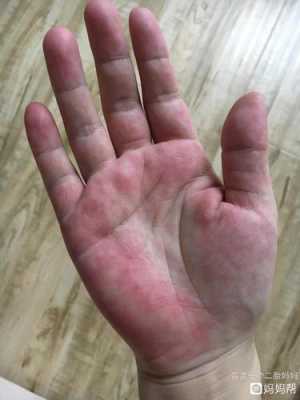 孕晚期突然手掌脚板痒是怎么回事,孕期手掌很痒怎么回事啊 第2张 孕晚期突然手掌脚板痒是怎么回事,孕期手掌很痒怎么回事啊 第2张