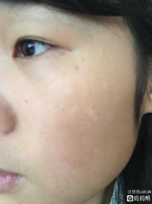 孕期长白斑是怎么回事(孕期长白斑是怎么回事儿) 第3张 孕期长白斑是怎么回事(孕期长白斑是怎么回事儿) 第3张