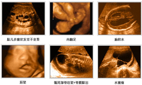 11周胎儿四维彩超图(11d在地理学中代表什么) 第3张 11周胎儿四维彩超图(11d在地理学中代表什么) 第3张
