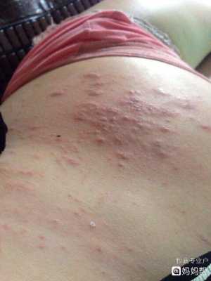 孕妇荨麻疹对胎儿的影响(孕妇身上起风团对胎儿有影响吗) 第1张 孕妇荨麻疹对胎儿的影响(孕妇身上起风团对胎儿有影响吗) 第1张