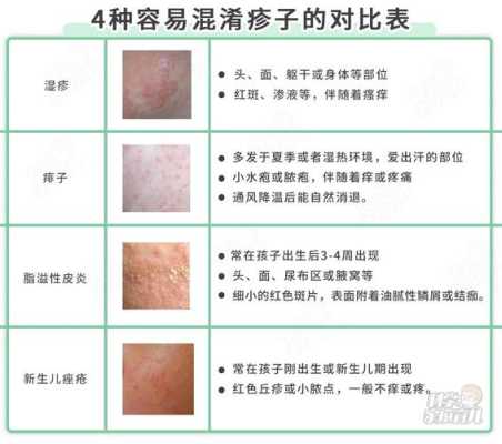 孕期湿疹很严重怎么办(孕妇得了湿疹怎么办) 第1张 孕期湿疹很严重怎么办(孕妇得了湿疹怎么办) 第1张
