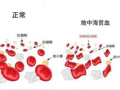 孕期地中海贫血的症状(孕期地中海贫血的症状表现) 第2张 孕期地中海贫血的症状(孕期地中海贫血的症状表现) 第2张
