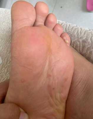 孕妇脚底起好多水泡怎么办,孕期嘴上起水泡怎么办图片 第2张 孕妇脚底起好多水泡怎么办,孕期嘴上起水泡怎么办图片 第2张