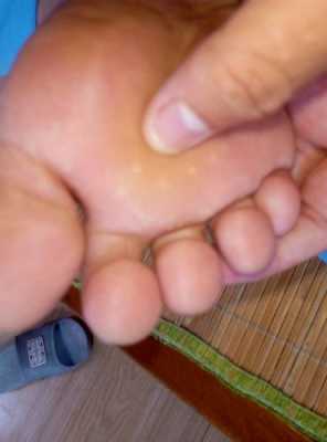 孕妇脚底起好多水泡怎么办,孕期嘴上起水泡怎么办图片 第1张 孕妇脚底起好多水泡怎么办,孕期嘴上起水泡怎么办图片 第1张