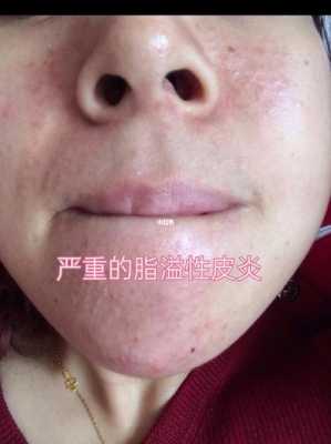 孕期脂溢性皮炎怎么办（孕期脂溢性皮炎怎么治）  第1张