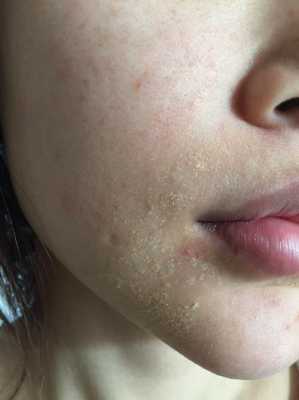 孕期脂溢性皮炎怎么办（孕期脂溢性皮炎怎么治）  第2张
