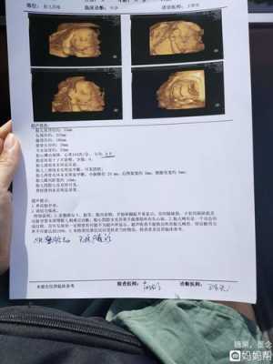 27周胎儿做四维彩超(27周胎儿做四维彩超要憋尿吗) 第2张 27周胎儿做四维彩超(27周胎儿做四维彩超要憋尿吗) 第2张