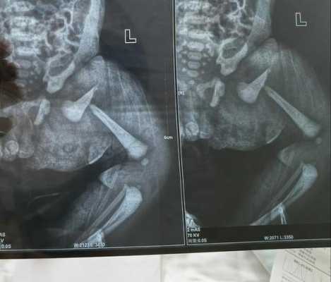 小孩大腿骨折有什么表现,胎儿骨折b超能看出来吗图片  第1张