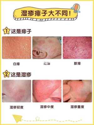 孕妇为什么生湿疹,怀孕期间长湿疹的原因有哪些 第1张 孕妇为什么生湿疹,怀孕期间长湿疹的原因有哪些 第1张