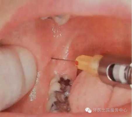 怀孕期间牙齿能打麻醉吗,怀孕期间打麻药的影响大吗 第1张 怀孕期间牙齿能打麻醉吗,怀孕期间打麻药的影响大吗 第1张