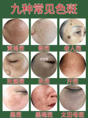 防止长斑的正确方法,怎么预防怀孕期间长斑的方法 第3张 防止长斑的正确方法,怎么预防怀孕期间长斑的方法 第3张