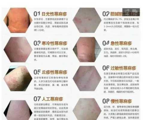 孕妇发荨麻疹怎么办,孕期荨麻疹怎么办呢图片  第1张