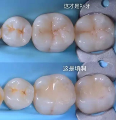 怀孕期间能不能补牙(怀孕期间能不能补牙洞) 第1张 怀孕期间能不能补牙(怀孕期间能不能补牙洞) 第1张