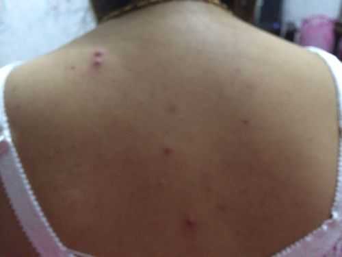 孕期一直长痘痘怎么办(怀孕后背上长了好多痘痘怎么办) 第1张 孕期一直长痘痘怎么办(怀孕后背上长了好多痘痘怎么办) 第1张