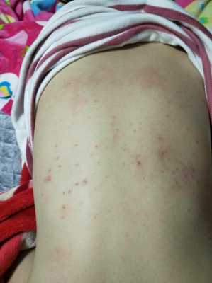 孕期一直长痘痘怎么办(怀孕后背上长了好多痘痘怎么办) 第2张 孕期一直长痘痘怎么办(怀孕后背上长了好多痘痘怎么办) 第2张