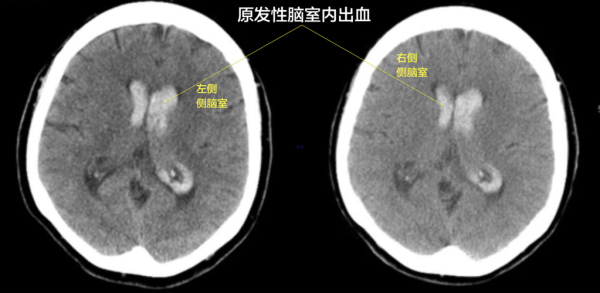 胎儿脑室出血(胎儿脑室出血) 第1张 胎儿脑室出血(胎儿脑室出血) 第1张