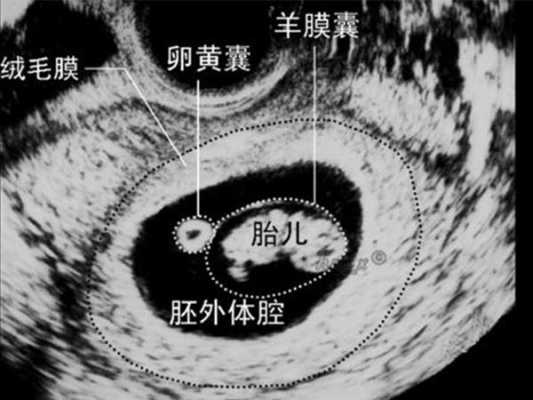 胎儿卵黄囊(胎儿卵黄囊什么时候出现) 第2张 胎儿卵黄囊(胎儿卵黄囊什么时候出现) 第2张