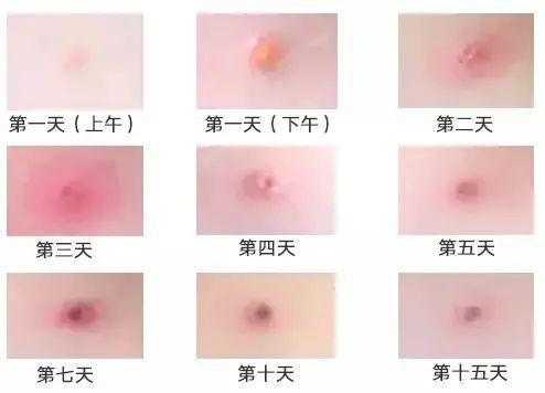 怀孕期间出水痘怎么办(怀孕期间出水痘怎么办呢) 第1张 怀孕期间出水痘怎么办(怀孕期间出水痘怎么办呢) 第1张