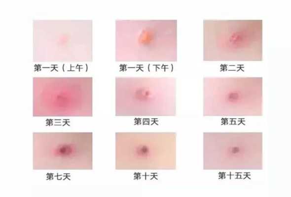 怀孕期间出水痘怎么办(怀孕期间出水痘怎么办呢) 第2张 怀孕期间出水痘怎么办(怀孕期间出水痘怎么办呢) 第2张