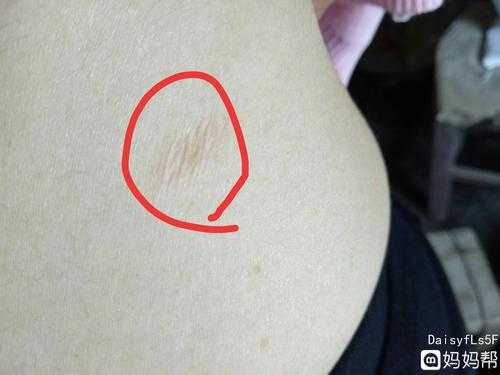 怀孕期间长藓怎么办(怀孕期间长癣怎么办) 第2张 怀孕期间长藓怎么办(怀孕期间长癣怎么办) 第2张