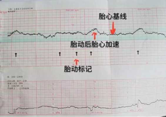 胎动时胎心不加速正常吗,胎儿心率过慢怎么办 第1张 胎动时胎心不加速正常吗,胎儿心率过慢怎么办 第1张