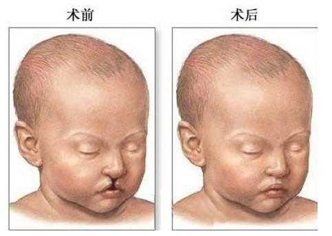 胎儿上颚裂(胎儿上颚裂图片) 第1张 胎儿上颚裂(胎儿上颚裂图片) 第1张