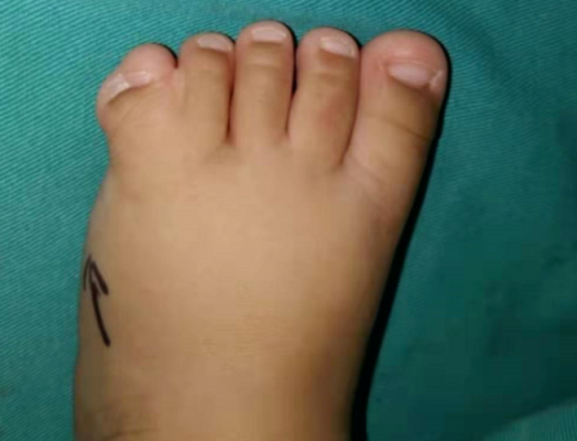 胎儿多脚趾(孩子脚趾遗传爸爸还是妈妈) 第3张 胎儿多脚趾(孩子脚趾遗传爸爸还是妈妈) 第3张