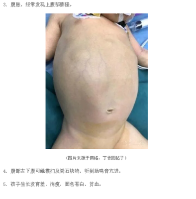 胎儿巨肠结（胎儿巨肠结 能确诊嘛）  第1张