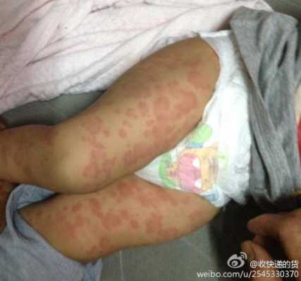小孩起风团怎么办,胎儿泡大小约17-8mm 第1张 小孩起风团怎么办,胎儿泡大小约17-8mm 第1张