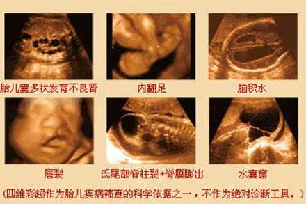 胎儿上唇图(胎儿上唇是什么意思) 第1张 胎儿上唇图(胎儿上唇是什么意思) 第1张