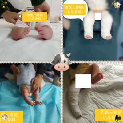 胎儿双脚内翻（宝宝脚内翻怎么纠正）  第2张