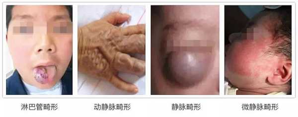胎儿血管畸形原因(胎儿畸形是什么原因造成的) 第1张 胎儿血管畸形原因(胎儿畸形是什么原因造成的) 第1张