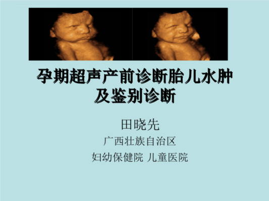 怀孕胎儿水肿有救吗,胎儿水肿如何治疗,孕期水肿好吗会胎停吗 第3张 怀孕胎儿水肿有救吗,胎儿水肿如何治疗,孕期水肿好吗会胎停吗 第3张