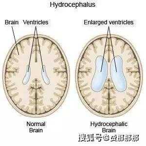导液管是什么东西,胎儿脑导水管形成时间 第3张 导液管是什么东西,胎儿脑导水管形成时间 第3张